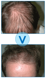 Avant et après la microgreffe de cheveux