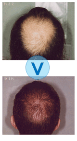 Avant et après une microgreffe de cheveux