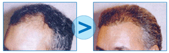 Résultats d'une microgreffe de cheveux
