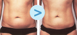 Lifting médical du ventre + abdomen