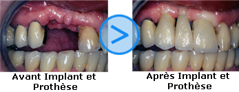 Photos avant/après d'implants dentaires