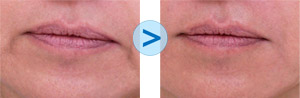 Botox : plis d'amertume