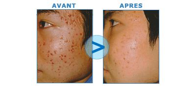 Rougeurs post-acnéiques traitées au laser