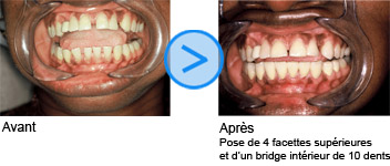 Photos avant / après de facettes dentaires