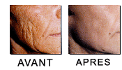 Photos avant/apr&egrave;s un peeling