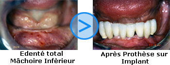Photos avant/apr&egrave;s d'implants dentaires