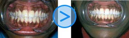 Photos Avant / Apr&egrave;s du blanchiment des dents