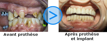 Photos avant/apr&egrave;s d'implants dentaires