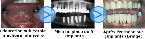 Photos avant/apr&egrave;s d'implants dentaires