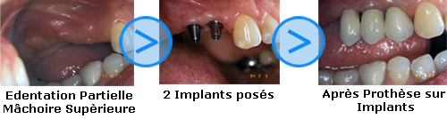 Photos avant/apr&egrave;s d'implants dentaires