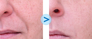 Botox : sillons naso-g&eacute;niens