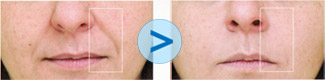 Injections de Juv&eacute;derm