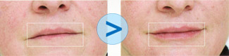 Injections de Juv&eacute;derm