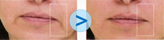Injections de Juv&eacute;derm