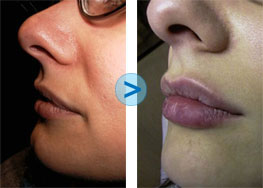 R�sultats du Bio-Alcamid sur les l�vres
