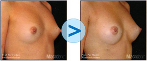 Macrolane augmentation mammaire