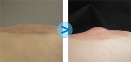 R�sultats du Bio-Alcamid sur le mamelon ombiliqu�