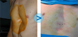 R�sultats du Bio-Alcamid sur le Pectus Excavatum