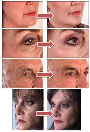 Photos avant/apr&egrave;s un peeling