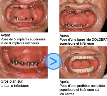 Photos avant / apr&egrave;s de facettes dentaires