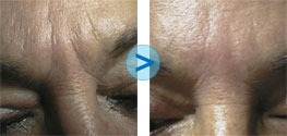 R�sultats du Bio-Alcamid sur les rides