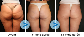 contre la cellulite