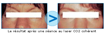 Photos avant/après le laser