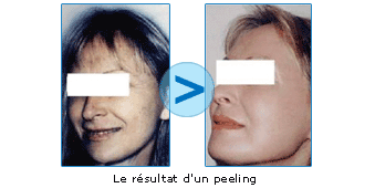 Photos avant/après un peeling