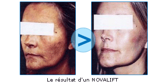 NOVALIFT