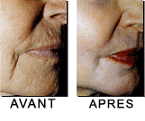 Photos avant/après un peeling