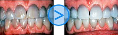 Photos Avant / Après du blanchiment des dents