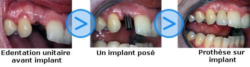 Photos avant/après d'implants dentaires