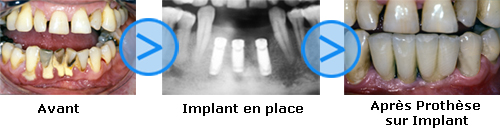 Photos avant/après d'implants dentaires