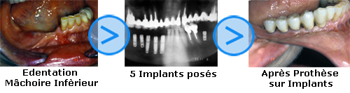 Photos avant/après d'implants dentaires