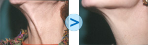 Botox : phanons du cou
