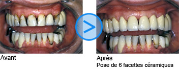 Photos avant / après de facettes dentaires