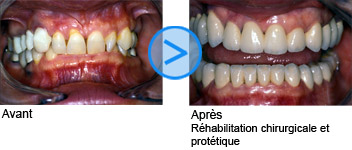 Photos avant / après de facettes dentaires