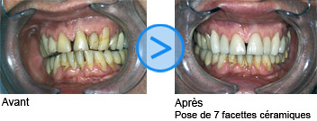 Photos avant / après de facettes dentaires