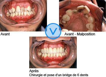 Photos avant / après de facettes dentaires