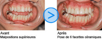 Photos avant / après de facettes dentaires