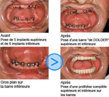 Photos avant / après de facettes dentaires