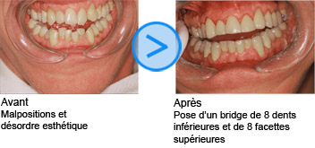 Photos avant / après de facettes dentaires