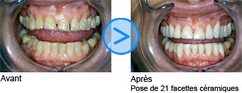 Photos avant / après de facettes dentaires