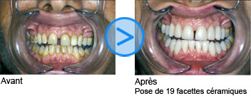 Photos avant / après de facettes dentaires