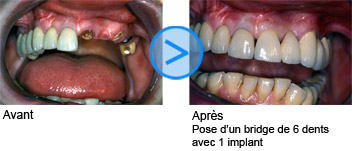 Photos avant / après de facettes dentaires