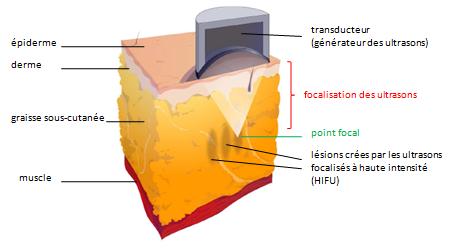 Technique du liposonix