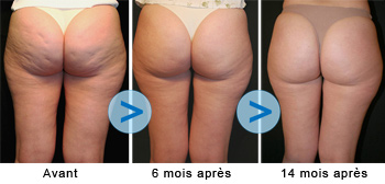 Thermofréquence contre la cellulite