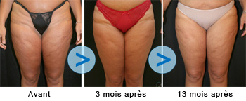 Thermofréquence contre la cellulite