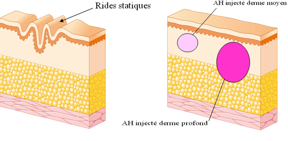 Injections de Juvéderm