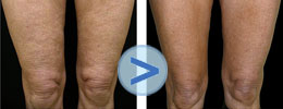 Photos thermage : Traitement sur les genoux
